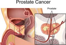 เปิดตัว! เครื่องตรวจมะเร็งต่อมลูกหมากด้วยการ “ดมกลิ่น” รอยโรคในปัสสาวะ