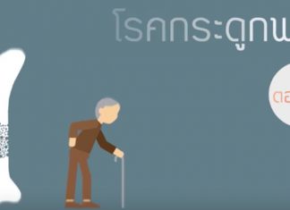 โรคกระดูกพรุน ตอนที่ 1: นิยามของโรค / ผู้ป่วยกลุ่มเสี่ยง