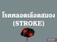 โรคหลอดเลือดสมอง (Stroke) คืออะไร โรคหลอดเลือดสมอง (Stroke) คืออะไร